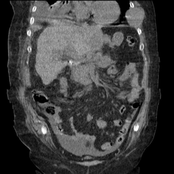 File:Acute tubular necrosis (Radiopaedia 28077-28334 D 36).jpg