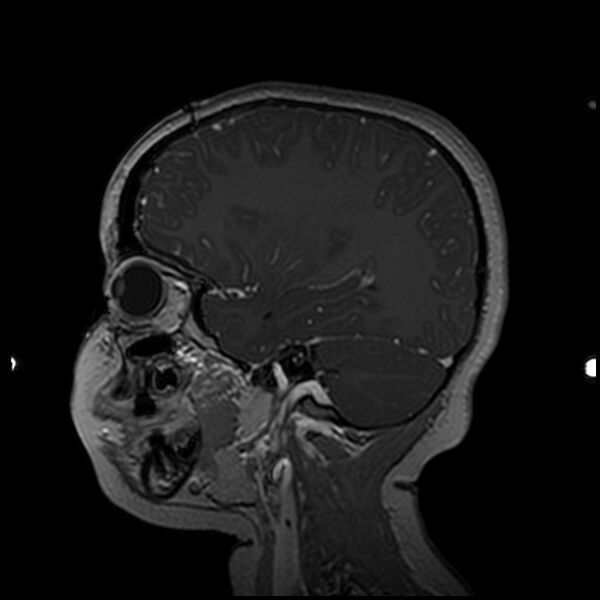 File:Adamantinomatous craniopharyngioma (Radiopaedia 77407-89529 H 84).jpg