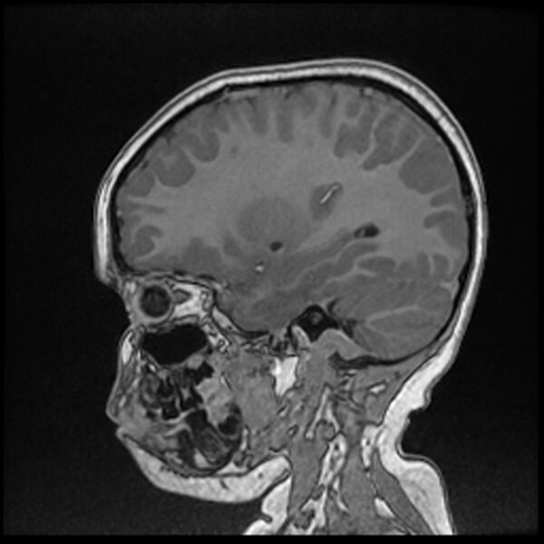 File:Adamantinomatous craniopharyngioma (Radiopaedia 77407-89529 Sagittal T1 C+ 43).jpg