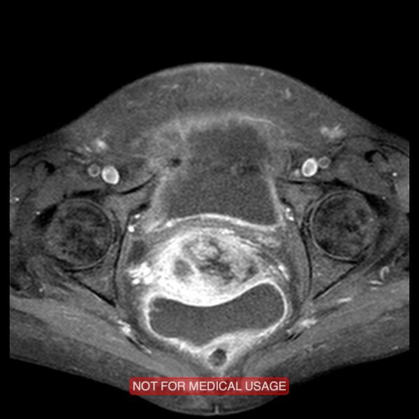 File:Adenocarcinoma of the cervix (Radiopaedia 28373-28615 Axial T1 C+ fat sat 7).jpg