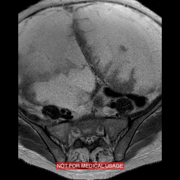 File:Adenocarcinoma of the cervix (Radiopaedia 28373-28615 Axial T2 22).jpg