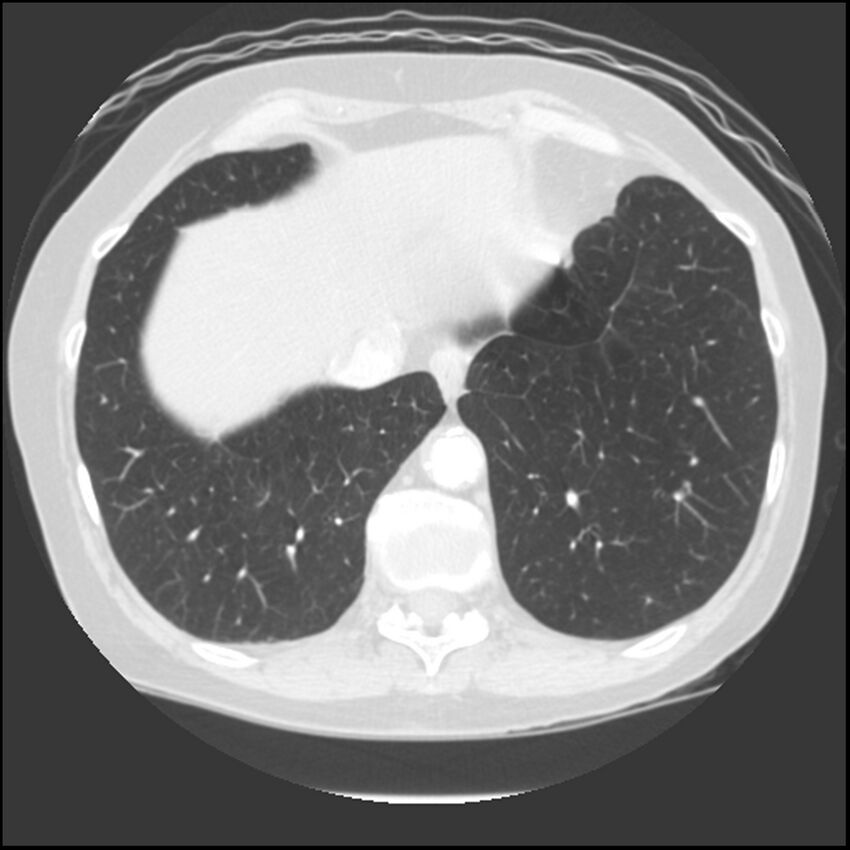 Adenocarcinoma of the lung (Radiopaedia 41015-43755 Axial lung window 100).jpg