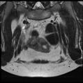 Adenoma malignum of the cervix (Radiopaedia 24460-24765 Coronal T2 4).jpg