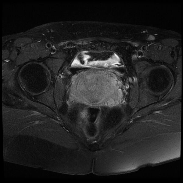 File:Adenomyosis-scar endometriosis (Radiopaedia 65863-75022 Axial T1 C+ fat sat 18).jpg
