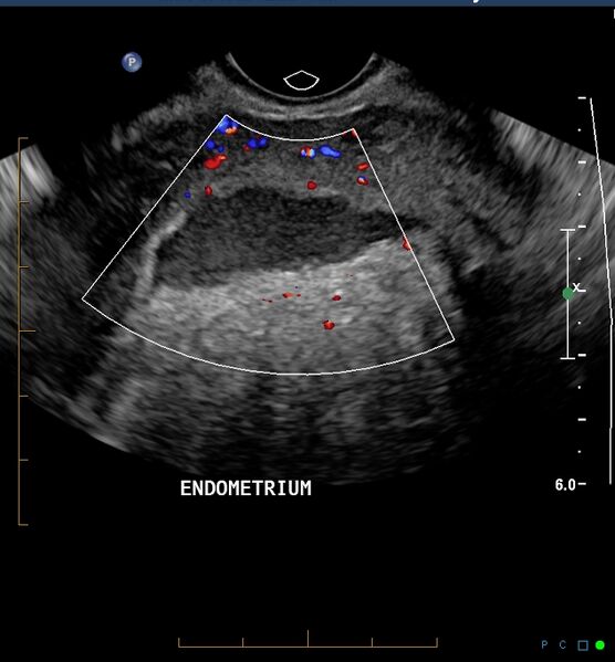 File:Adenomyosis uterus with hematometra (Radiopaedia 45779-51705 D 1).jpg