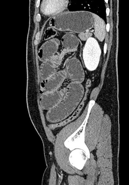 File:Adhesional small bowel obstruction (Radiopaedia 58900-66131 Sagittal C+ portal venous phase 196).jpg