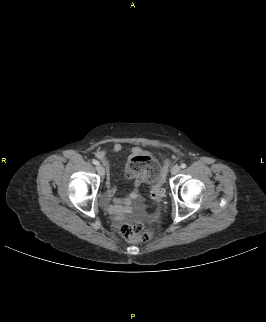 Adhesional small bowel obstruction (Radiopaedia 85402-101024 Axial C+ portal venous phase 261).jpg