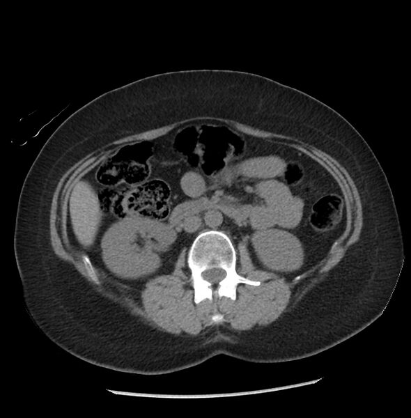 File:Adrenal cortical carcinoma with IVC invasion and thrombosis (Radiopaedia 34307-35597 Axial non-contrast 28).jpg