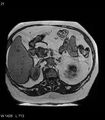 Adrenal myelolipoma (Radiopaedia 6765-7961 Axial T1 out-of-phase 21).jpg