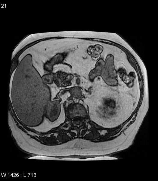 File:Adrenal myelolipoma (Radiopaedia 6765-7961 Axial T1 out-of-phase 21).jpg