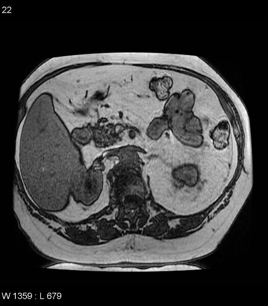 File:Adrenal myelolipoma (Radiopaedia 6765-7961 Axial T1 out-of-phase 22).jpg