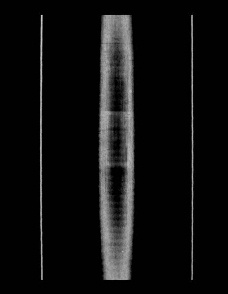 File:Adrenal myelolipoma - bilateral (Radiopaedia 74805-85810 Coronal C+ portal venous phase 5).jpg