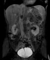 Adrenocortical carcinoma (Radiopaedia 11176-11541 G 1).jpg