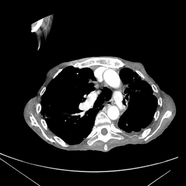 File:Advanced pulmonary tuberculosis (Radiopaedia 8599-9431 Axial liver window 8).jpg