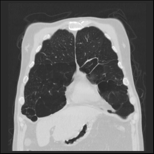 File:Alpha-1-antitrypsin deficiency (Radiopaedia 40993-43722 Coronal lung window 17).jpg
