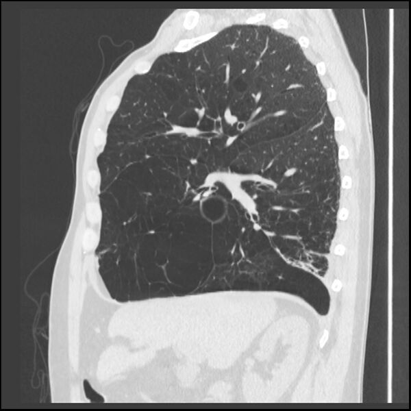 File:Alpha-1-antitrypsin deficiency (Radiopaedia 40993-43722 Sagittal lung window 178).jpg