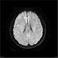Amnestic syndrome secondary to hypoxic brain injury (Radiopaedia 24743-25004 DWI 20).jpg