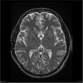 Amnestic syndrome secondary to hypoxic brain injury (Radiopaedia 24743-25004 T2 11).jpg