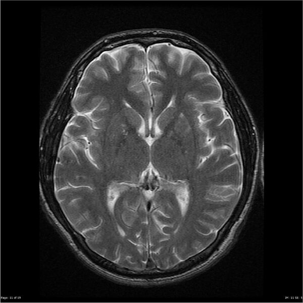 File:Amnestic syndrome secondary to hypoxic brain injury (Radiopaedia 24743-25004 T2 11).jpg