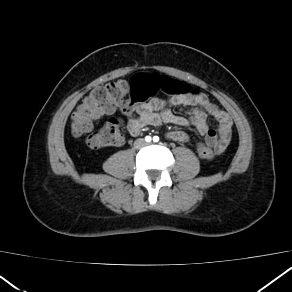 File:Ampullary tumor (Radiopaedia 22787-22816 B 55).jpg