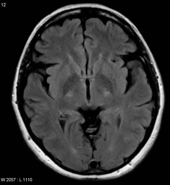 File:Amyotrophic lateral sclerosis (Radiopaedia 5373-7134 Axial FLAIR 12).jpg