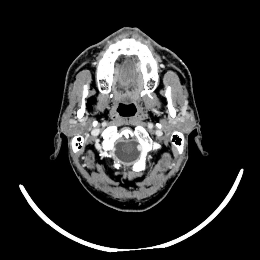 Anaplastic thyroid carcinoma (Radiopaedia 79087-92034 B 106).jpg