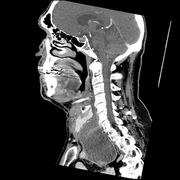 File:Anaplastic thyroid carcinoma (Radiopaedia 79087-92034 C 44).jpg