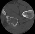 Aneurysmal bone cyst of ischium (Radiopaedia 25957-26094 B 39).png