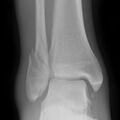 Ankle fracture - Weber B (Radiopaedia 2742-6425 Oblique 1).jpg