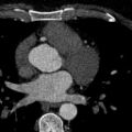 Anomalous origin of the left coronary artery with malignant course (Radiopaedia 77842-90126 C 74).jpeg