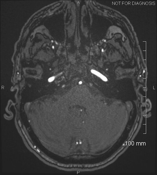 File:Anterior cerebral artery aneurysm (Radiopaedia 80683-94127 Axial MRA 48).jpg