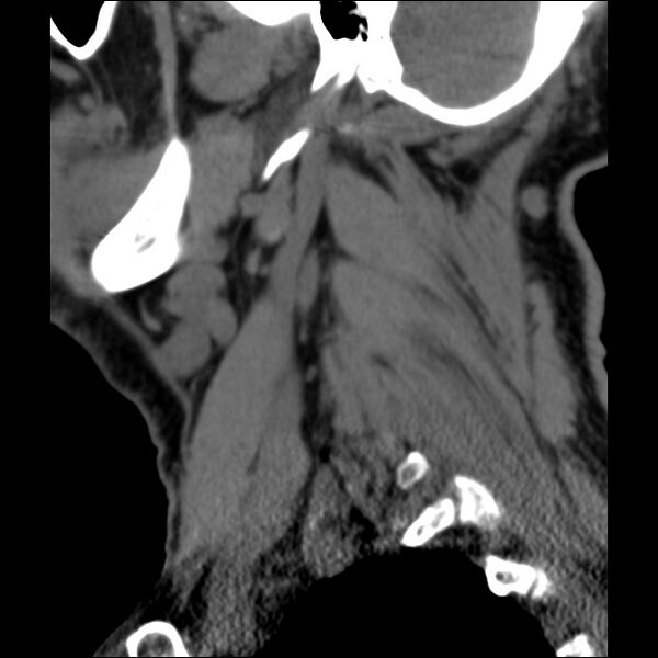 File:Anterior cervical postdiscectomy arthrodesis (Radiopaedia 32678-33646 C 41).jpg
