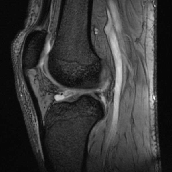 File:Anterior cruciate ligament tear - ramp lesion (Radiopaedia 71883-82322 Sagittal T2 fat sat 11).jpg