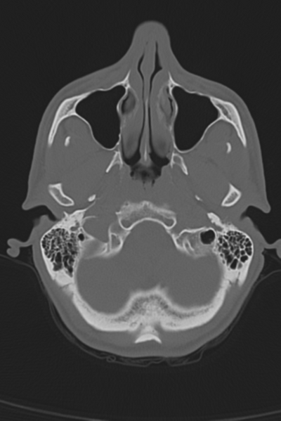 File:Anterior nasal spine fracture (Radiopaedia 46138-50494 Axial bone window 49).png