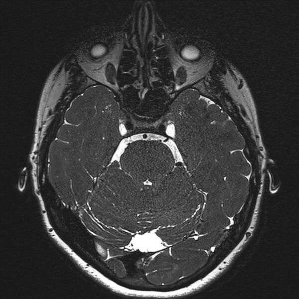 File:Anterior temporal encephalocele (Radiopaedia 82624-96808 Axial T2 high res 51).jpg