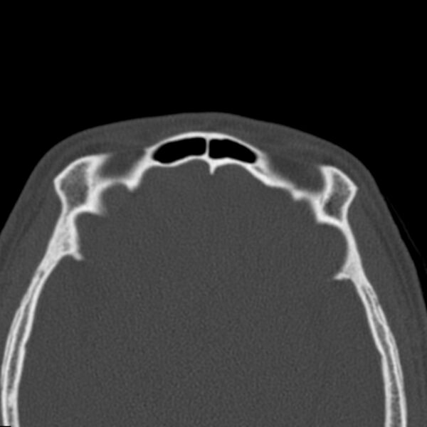 File:Antrochoanal polyp (Radiopaedia 21894-21868 Axial bone window 41).jpg