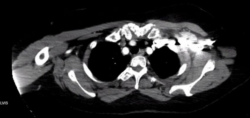 Aortic Dissection (Radiopaedia 85272-100847 A 2).jpg