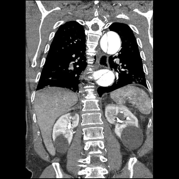 File:Aortic dissection - DeBakey Type I-Stanford A (Radiopaedia 79863-93115 B 27).jpg