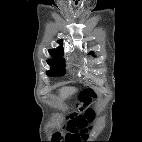 File:Aortic dissection - DeBakey Type I-Stanford A (Radiopaedia 79863-93115 B 7).jpg