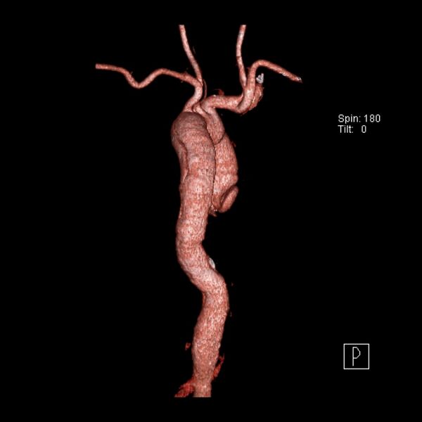 File:Aortic dissection - De Bakey type III - Stanford B (Radiopaedia 21903-21882 3D C+ arterial phase 10).jpg