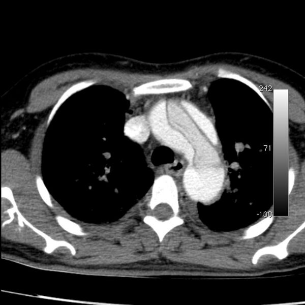 File:Aortic dissection - Stanford type A (Radiopaedia 29247-29659 A 23).jpg