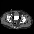 Aortic dissection with rupture into pericardium (Radiopaedia 12384-12647 A 84).jpg