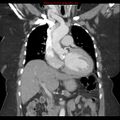 Aortic valve stenosis (Radiopaedia 14480-14423 A 9).jpg