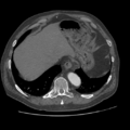 Aorto-coronary bypass graft aneurysms (Radiopaedia 40562-43157 A 103).png