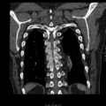 Aorto-coronary bypass graft aneurysms (Radiopaedia 40562-43157 B 37).png
