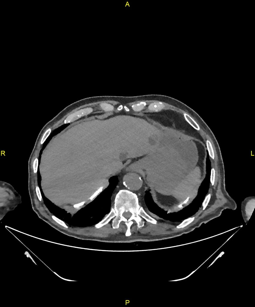 Aortoenteric fistula (Radiopaedia 84308-99603 Axial non-contrast 33).jpg