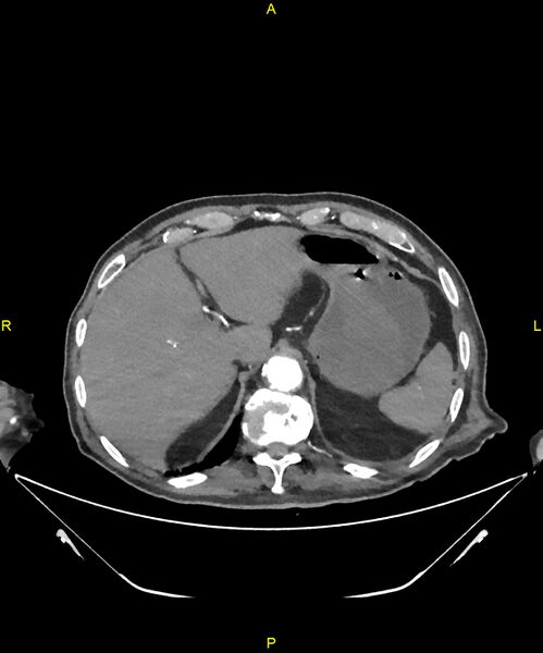 File:Aortoenteric fistula (Radiopaedia 84308-99603 B 53).jpg