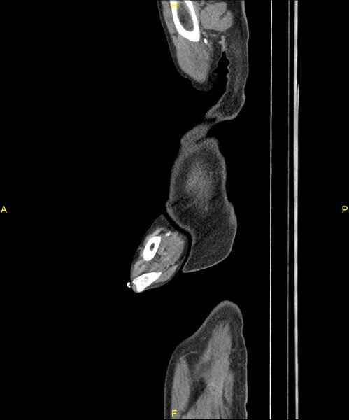 File:Aortoenteric fistula (Radiopaedia 84308-99603 C 6).jpg