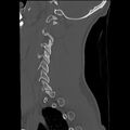 Apical pneumothorax on cervical spine CT (Radiopaedia 45343-49368 Sagittal bone window 29).jpg