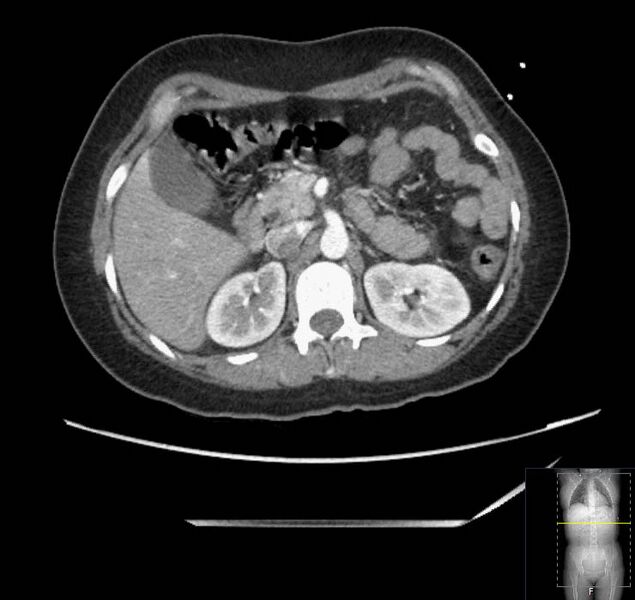 File:Appendicitis (CT angiogram) (Radiopaedia 154713-127660 Axial 135).jpg